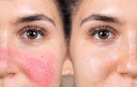 Rosacea Skin Care